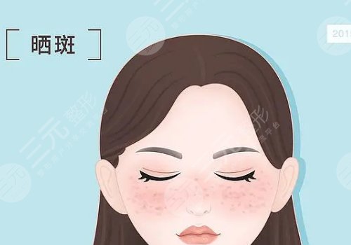 曬斑如何淡化或去掉？