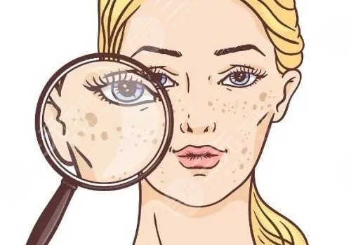 曬斑如何淡化或去掉？
