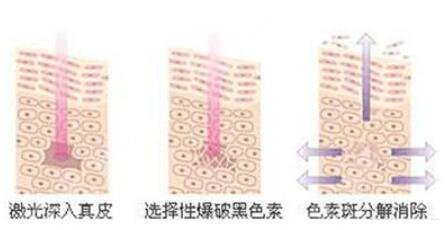 黑臉娃娃與光子嫩膚有什么區(qū)別?