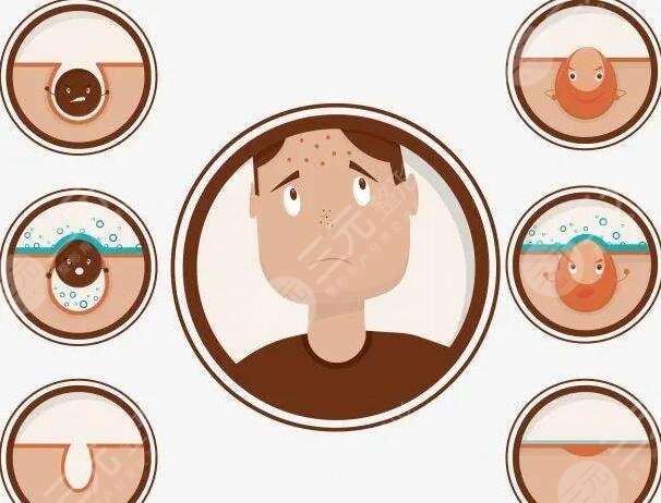 男生祛痘的小竅門是什么?