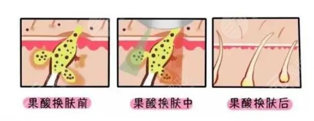 醫(yī)院果酸多少錢一次