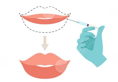 唇部注射玻尿酸需要注意什么？