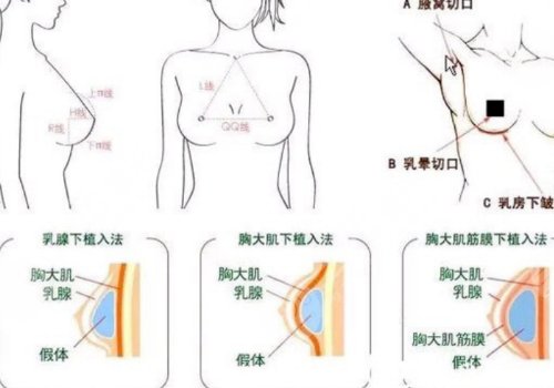 隆胸乳暈切口的優(yōu)缺點(diǎn)