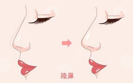 玻尿酸隆鼻有副作用嗎