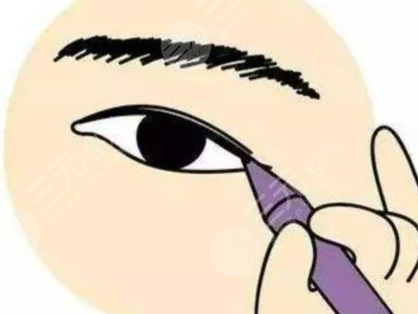 雙眼皮手術(shù)