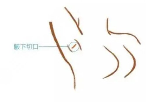 隆胸腋下切口的優(yōu)勢和缺點有哪些？