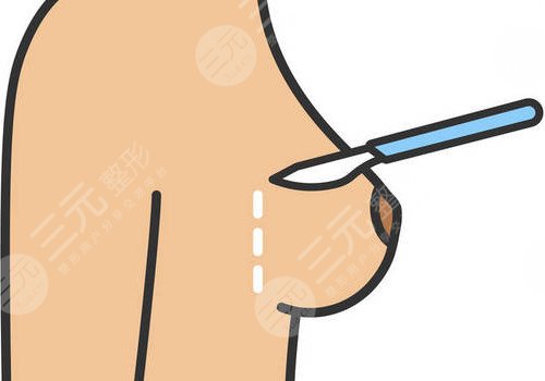 隆胸腋下切口的優(yōu)勢和缺點有哪些？