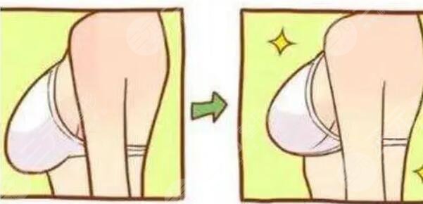 假體隆胸對身體有傷害嗎