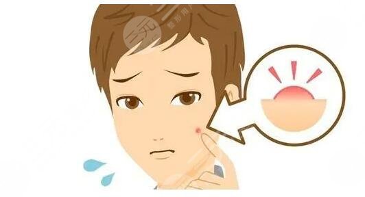 激光去痘印之后應(yīng)該怎樣去護理?