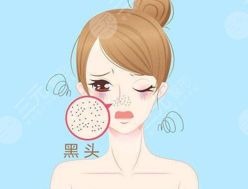 去黑頭有哪些方法?