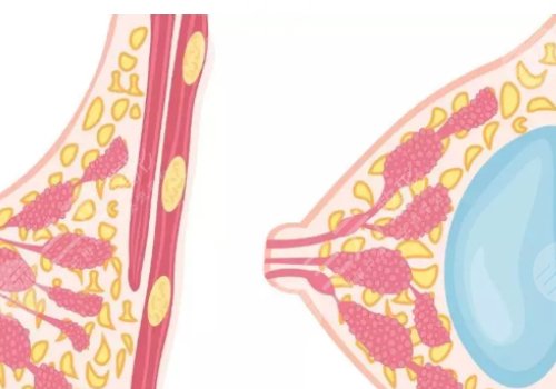 雙平面豐胸和普通豐胸的區(qū)別