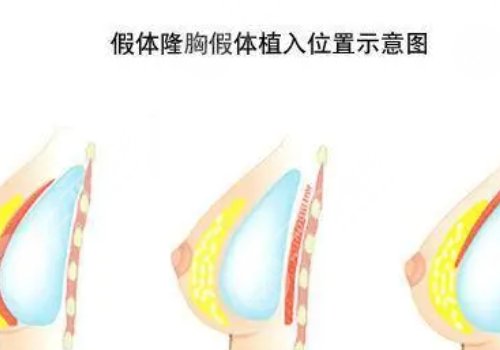 雙平面豐胸和普通豐胸的區(qū)別