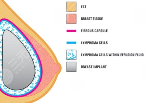 雙平面豐胸和普通豐胸的區(qū)別