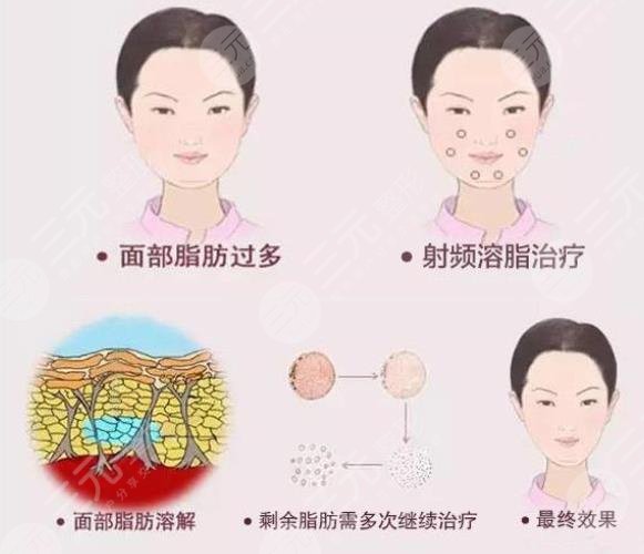 嘟嘟肉吸脂前后照片