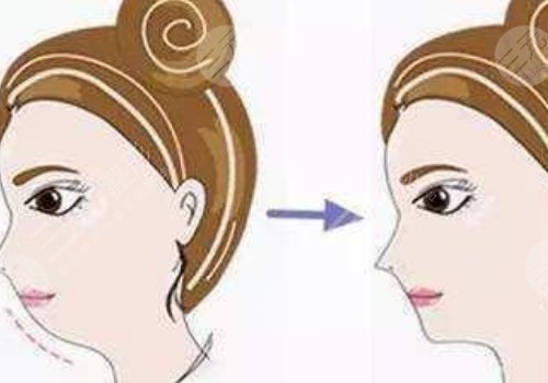 臉部輪廓固定怎么做？
