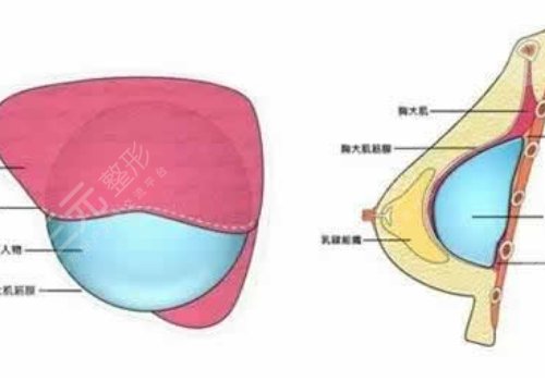 光面假體隆胸后需要怎么樣按摩？