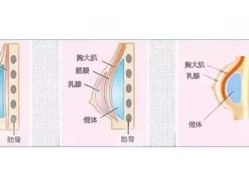 光面假體隆胸后需要怎么樣按摩？