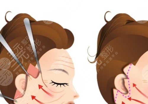 小拉皮和大拉皮的區(qū)別在哪里？