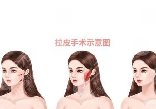 小拉皮和大拉皮的區(qū)別在哪里？