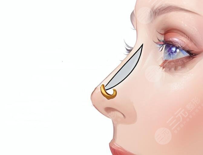 做了直鼻微翹之后可以用維持多長(zhǎng)時(shí)間?