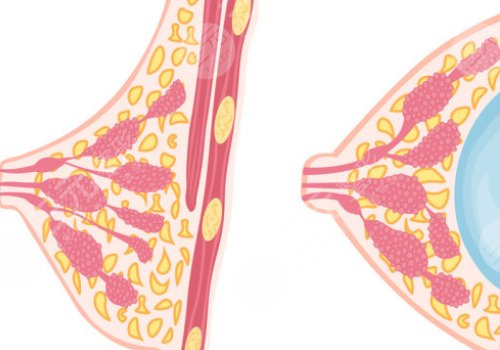 光面假體和毛面假體的優(yōu)缺點