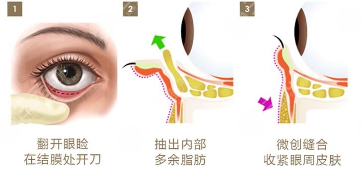 外切眼袋一般要多久才能完全恢復(fù)