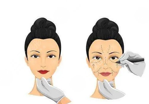 微調(diào)整形有風(fēng)險(xiǎn)嗎？