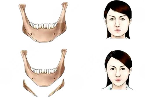 國字臉削骨手術(shù)風(fēng)險(xiǎn)大嗎？