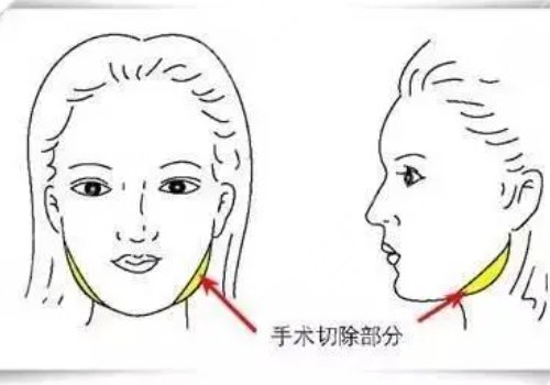 做臉部輪廓手術(shù)風(fēng)險(xiǎn)高嗎？