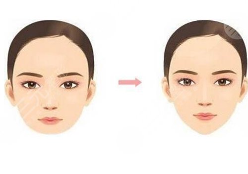 做臉部輪廓手術(shù)風(fēng)險(xiǎn)高嗎？