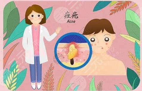 痤瘡佳緩解方法