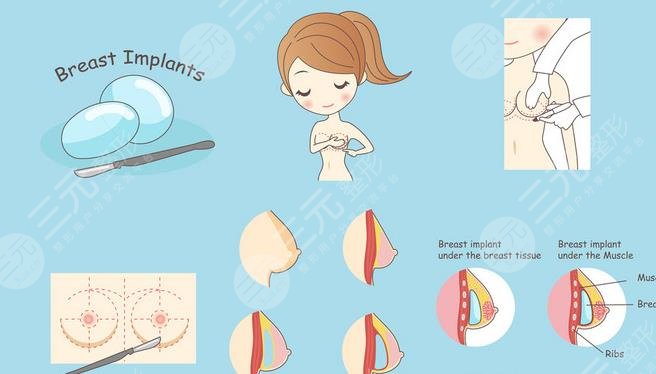 光面假體容易包膜攣縮嗎？會移位嗎？