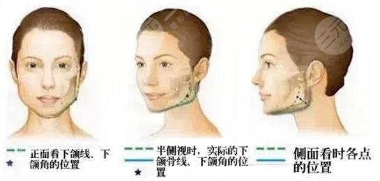 國字臉削骨手術(shù)風(fēng)險(xiǎn)大嗎？