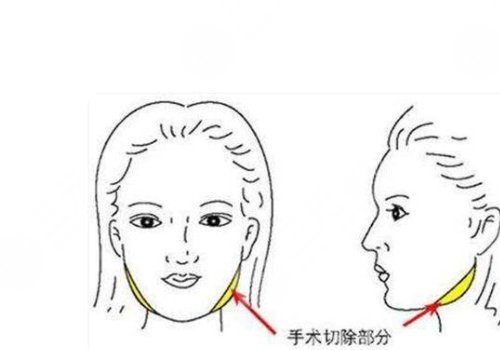 削骨三年后的真實案例圖片