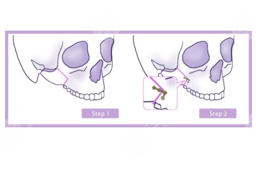削骨三年后的真實案例圖片