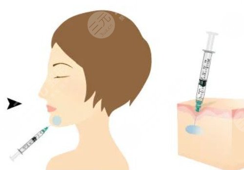 正規(guī)醫(yī)院注射除皺價格是多少？