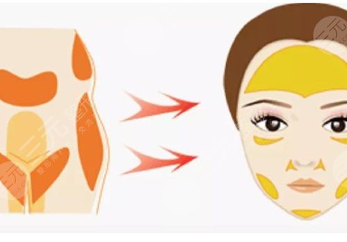 改良臉部輪廓做什么整形手術(shù)好？