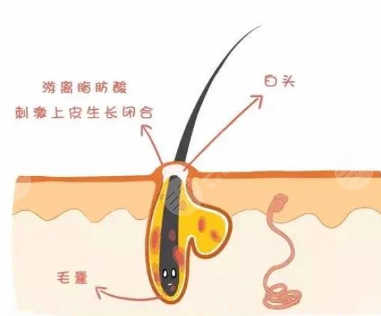 閉合性粉刺怎么徹底去除