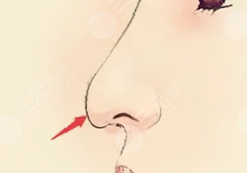 微調(diào)整形都有什么項目?