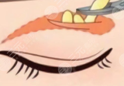 微調(diào)整形都有什么項目?