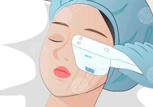 微調(diào)整形都有什么項目?