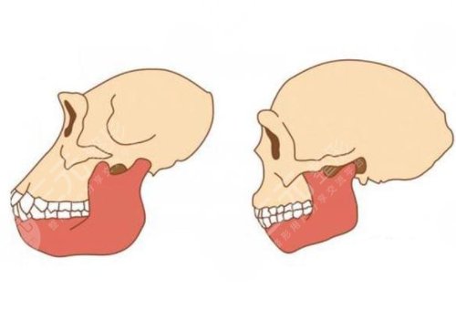 國(guó)字臉削骨手術(shù)后遺癥有什么?