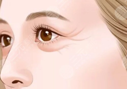 電波拉皮多久做一次合適？