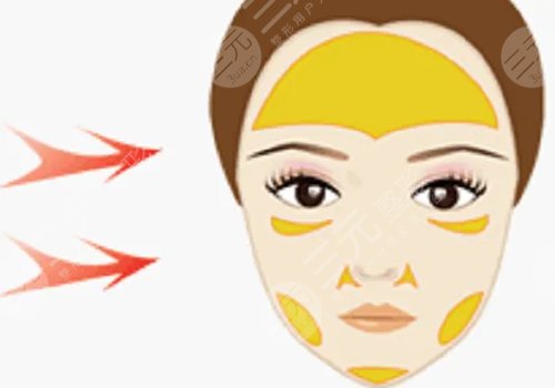 電波拉皮多少錢做一次？