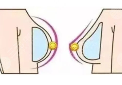 水滴形假體和圓形假體哪個(gè)更好看?