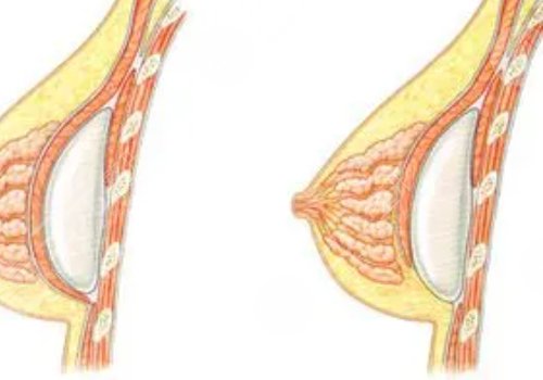 水滴形假體隆胸多少錢？