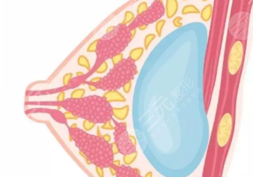水滴形假體隆胸多少錢？