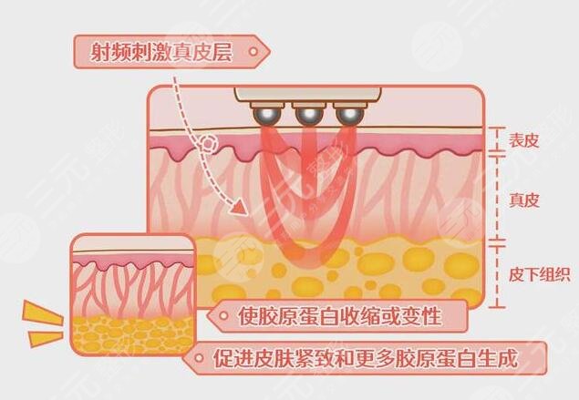 電波拉皮除皺的操作原理以及作用