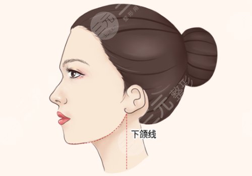 面部輪廓整形包括哪些種類(項(xiàng)目)？