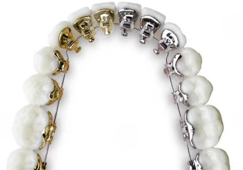 牙齒矯正多少錢價(jià)格表2023